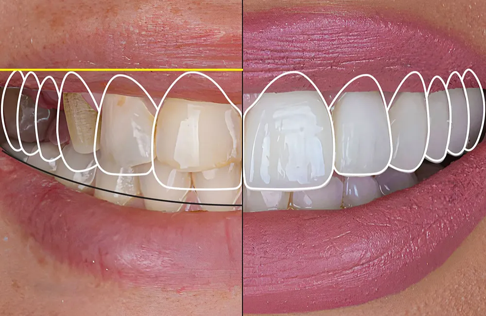 Digital Smile Design