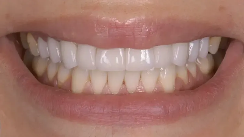 crowns bridges after 2