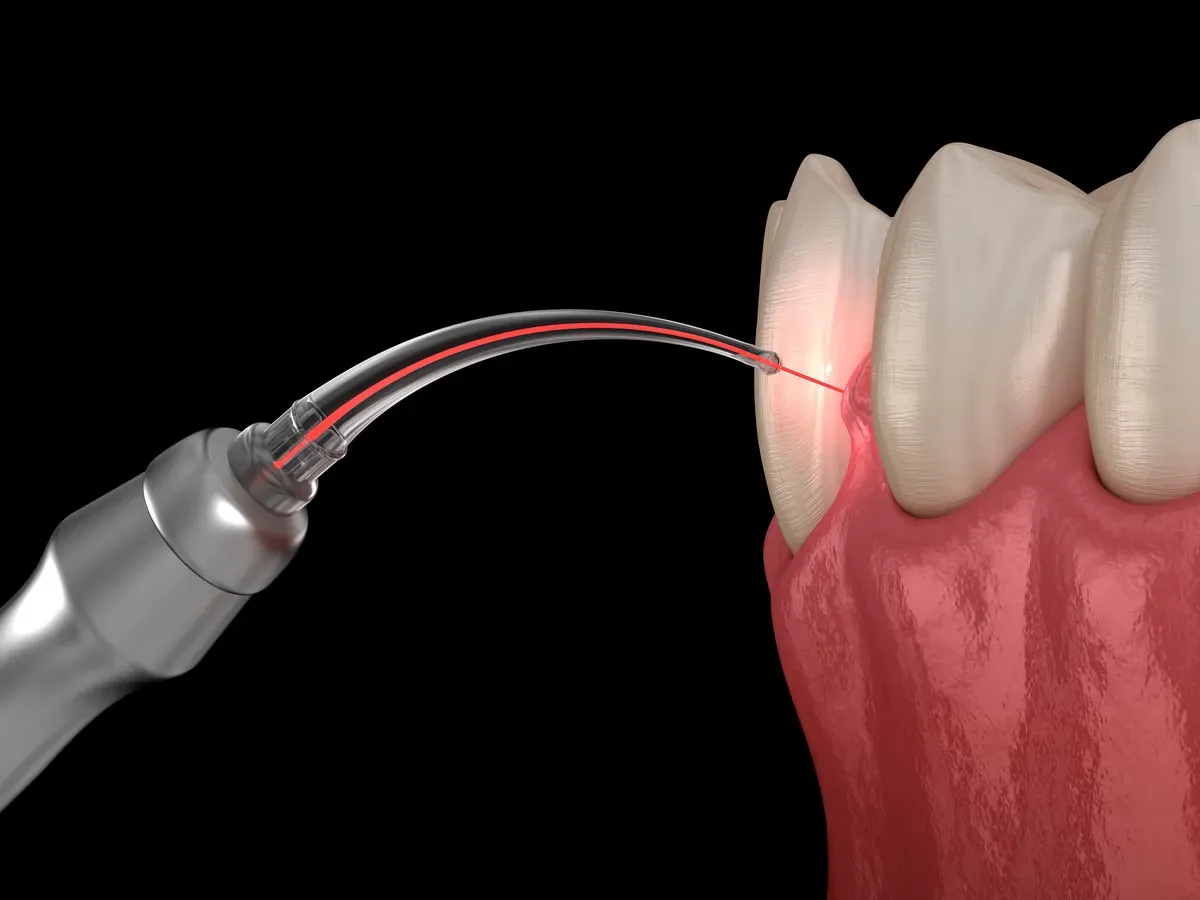 Laser Periodontal Therapy