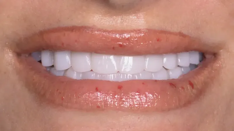 smile makeover after 1