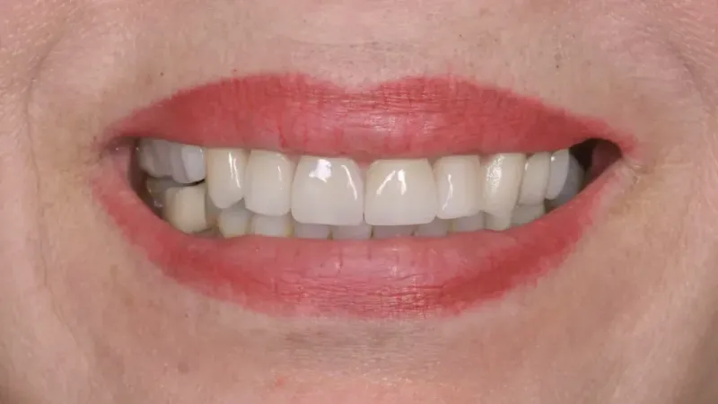 smile makeover after 4