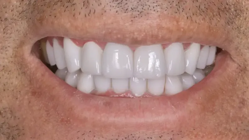 smile makeover after 5