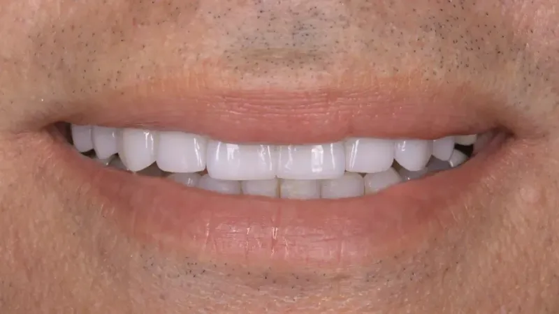 smile makeover after 6
