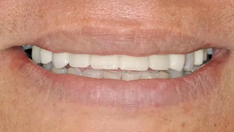 smile makeover after 7