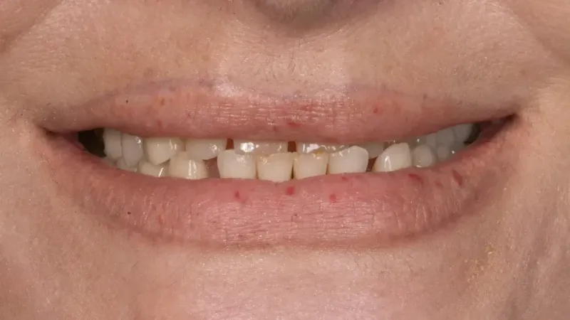 smile makeover before 1