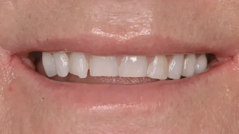 smile makeover before 2