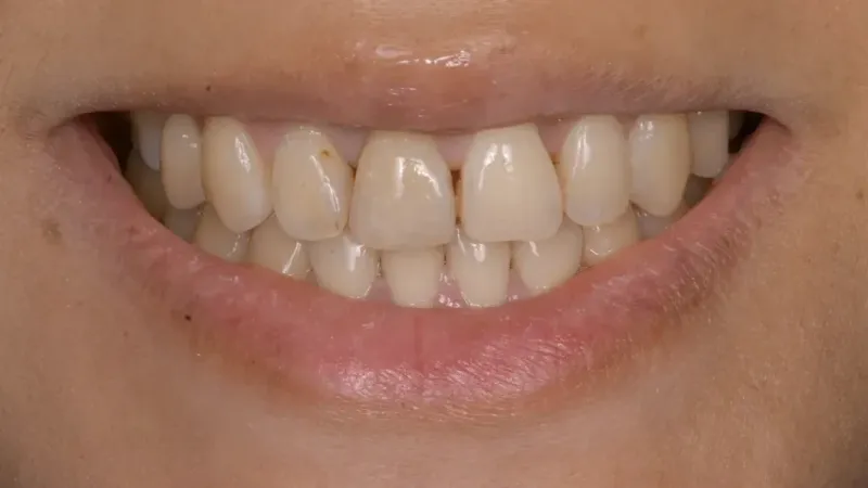 smile makeover before 3