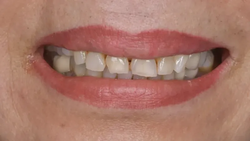 smile makeover before 4